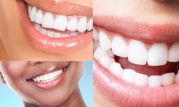 Gülüş Tasarımı ve Estetik Gülüşler Nedir?