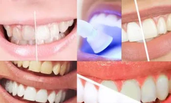 Çapraşık Diş ve Kapanış Kusurları Nasıl Tedavi Edilir