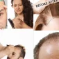 Best Hair Transplant Clinic İn Turkey Türkiyedeki En İyi Saç Ekim Kliniği