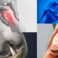 Menisküs Nedir ve Menisküs Yaralanması Nasıl Oluşur?