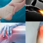 Pes Cavus Tedavisi Nedir?