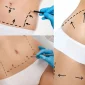 Vaser Liposuction Sonrası İyileşme Süreci Nasıldır?