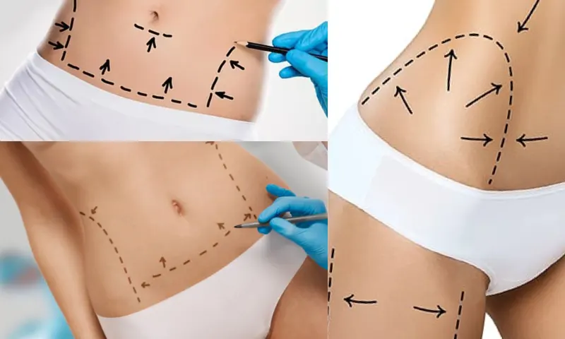 Vaser Liposuction Sonrası İyileşme Süreci Nasıldır?